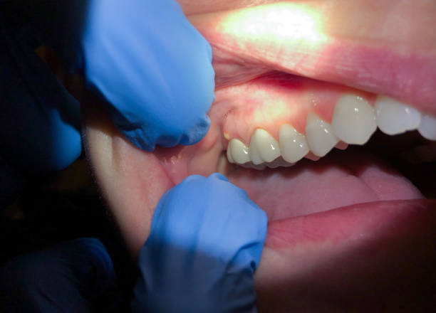 Best Emergency Treatment for Toothache in Morristown, TN